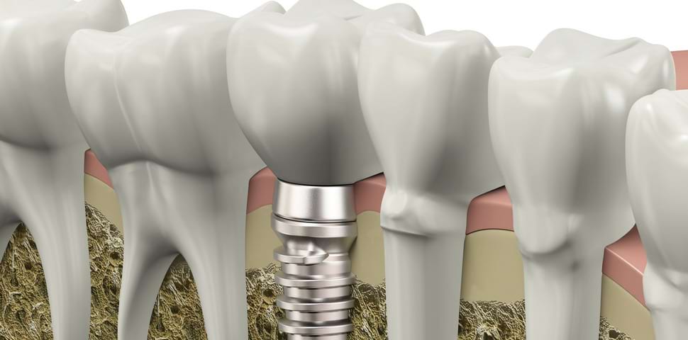 Ako ste izgubili zub, dentalni implanti su najbolje   rešenje