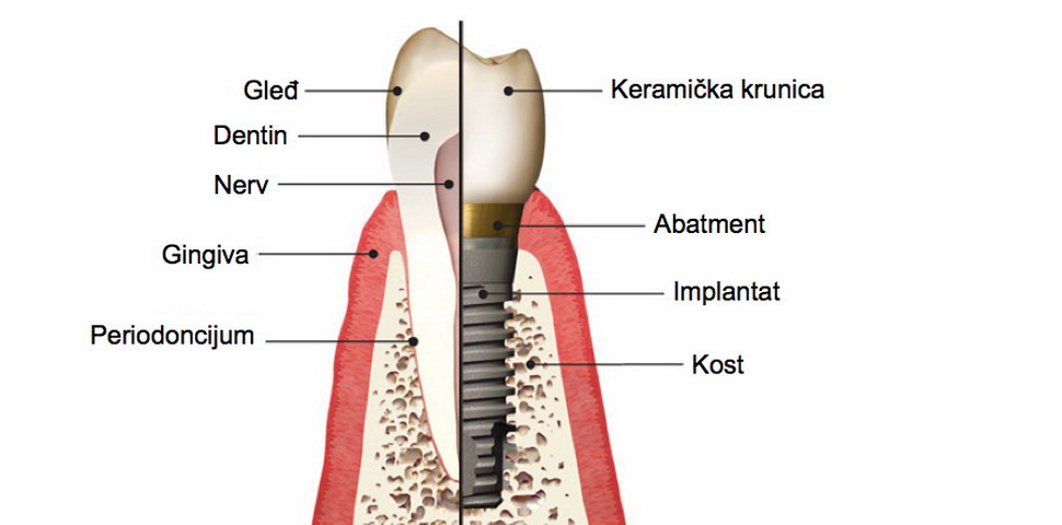 Procedura ugradnje implantata